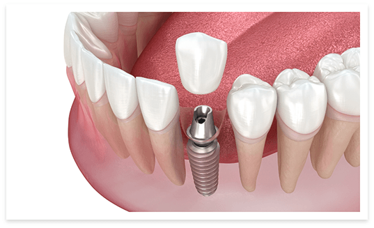 How dental implants work in Cary