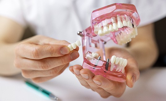 Dentist placing an implant bridge onto a mouth mold