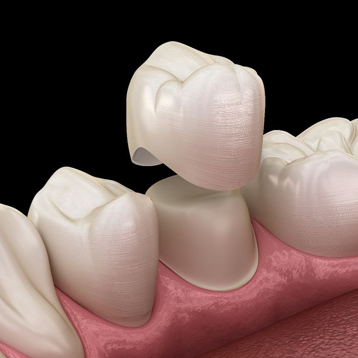 A dental crown being placed on a tooth