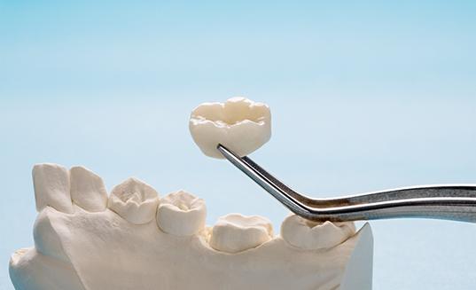 A dental crown being held by a forceps
