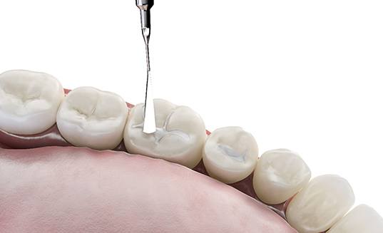 Rendering of composite resin filling applied to lower arch of teeth