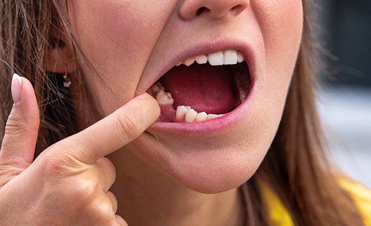 Person with a gap in their lower arch