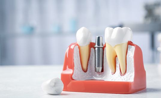 Single dental implant in mouth mold