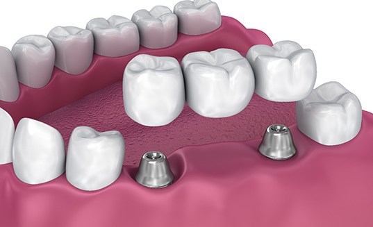 Digital image of an implant bridge