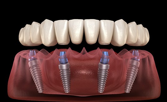 Detailed look at an implant denture